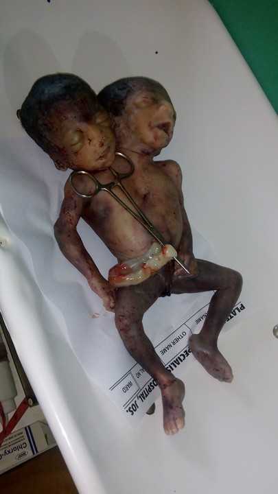 Conjoined Twins Delivered In Jos Die (graphic Pictures)